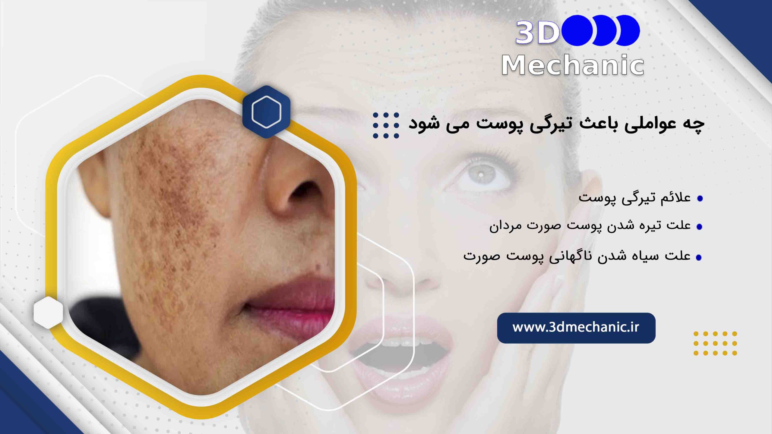 چه عواملی باعث تیرگی پوست می شود + علائم تیرگی پوست